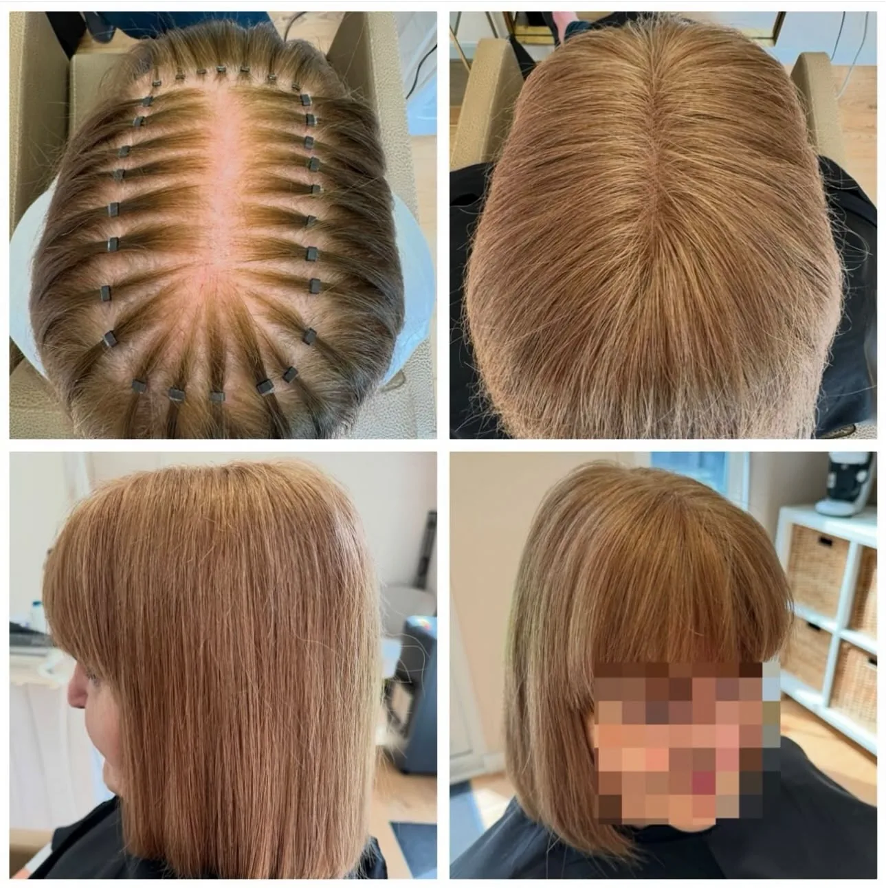 Hair loss integration transformation showing natural coverage